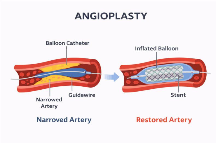 Interventional Cardiology